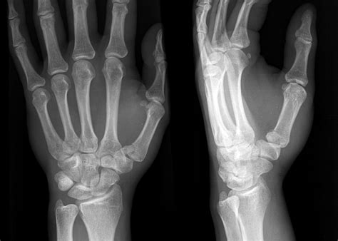 rolandos fracture wikidoc