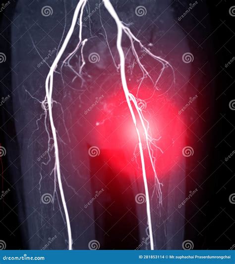 Cta Femoral Artery Run Off Image Of Femoral Artery Stock Photo
