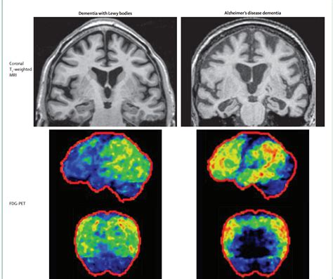Demencia Con Cuerpos De Lewy Medical Gabeents