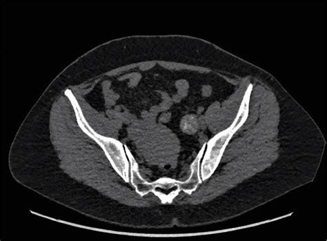 Figure 1 From A Rare Presentation Of Polypoid Endometriosis Of The