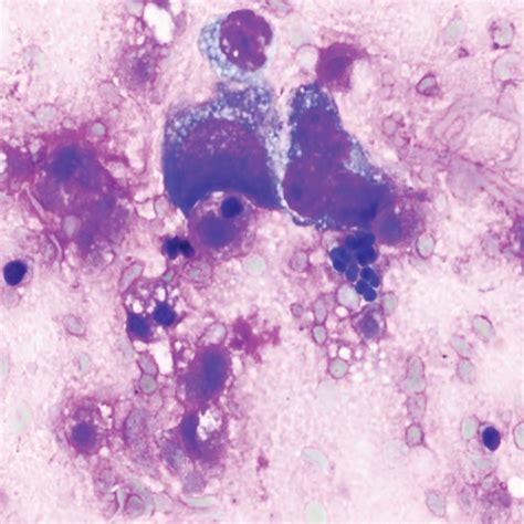 Biopsy showing (A) squamous mucosa with acute inflammation and reactive ...