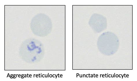 Hematology Archives Eclinpath