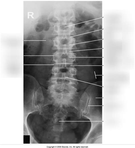 Lumbar Spine X Ray Diagram Quizlet