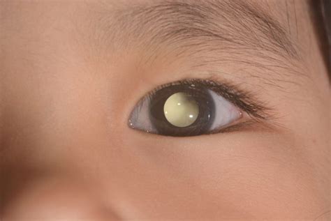 What Is Retinoblastoma Everything You Need To Know