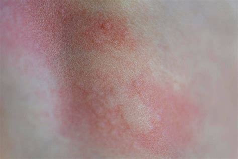 248 Allergic Reaction Rash Photos, Pictures And Background Images For ...