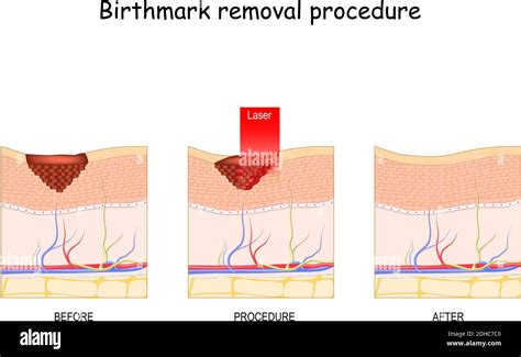 Birthmark Laser Removal Treatment Before And After Procedure Stock