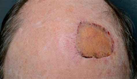 Post Op Wound Healing & Care - Dr Stretch