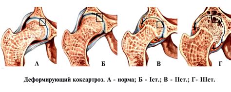 Массаж при коксартрозе тазобедренного сустава: техника проведения