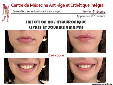 Injection Acide Hyaluronique Bordeaux Hydrater et Redessiner Lèvres