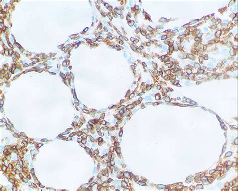 Cd3 Immunohistochemical Stain Of The Atypical Lymphocytes With Download Scientific Diagram