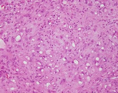 Soft Tissue Tumors of the Mediastinum | Basicmedical Key