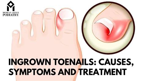 Ingrown Toenails Causes Symptoms And Treatment