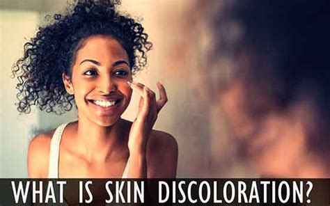 Skin Discoloration – Types, Causes, Treatment, & Much More - Health