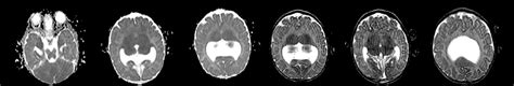 15 T Mri Showing Mega Cisterna Magna Rudimentary Anterior Falx