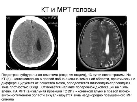 ГМ. Гематомы. Гематома. + | Портал радиологов