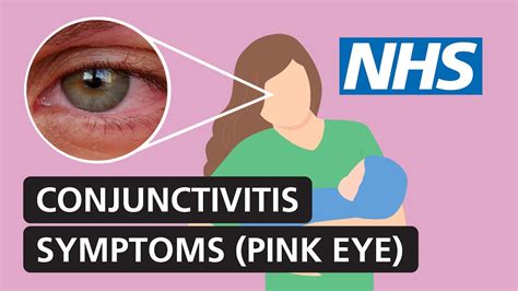 Conjunctivitis: symptoms and treatment for red, itchy, watery eyes ...