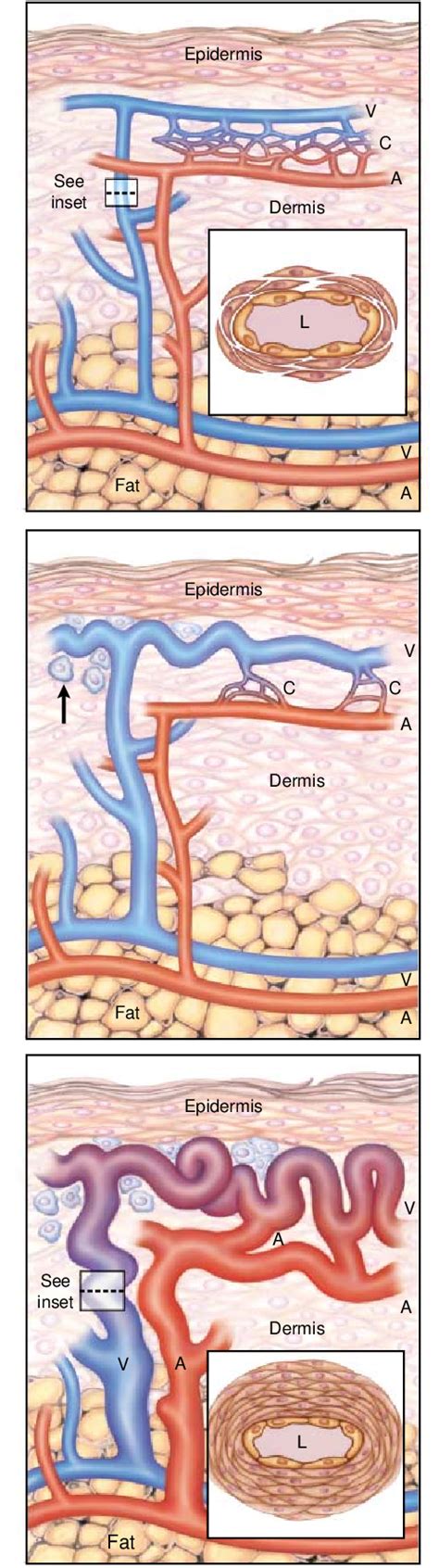 Figure 1 From Hereditary Hemorrhagic Telangiectasia Semantic Scholar