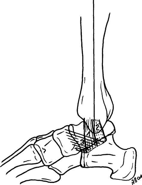 Tibiospring Ligament