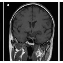 Pre Operative MRI T1 Weighted Axial A And Coronal B Sequences