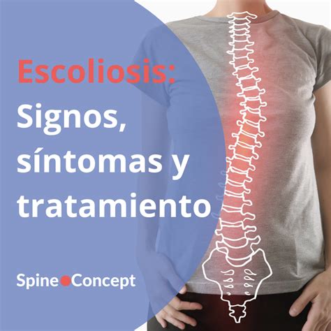 Qu Es La Escoliosis Tratamiento En Spine Concept Spine Concept