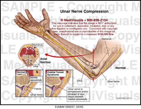 Nerve Entrapment Ulnar Nerve Entrapment Surgery Video