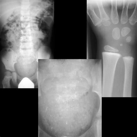 Lead Poisoning | Pediatric Radiology Reference Article | Pediatric