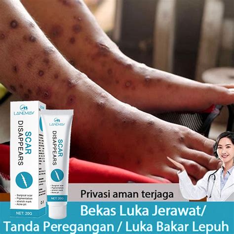 Jual Salep Penghilang Bekas Luka Penghilang Bekas Luka Hitam Koreng