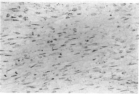 High Power Section Of Kaposis Sarcoma Tumour Showing It To Be Composed