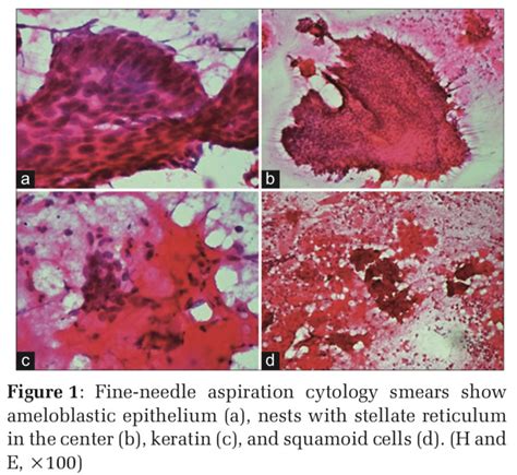 Fine Needle Aspiration Cytology Of Acanthomatous Ameloblastic Carcinoma