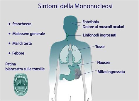 Mononucleosi La Malattia Del Bacio Conoscerla E Combatterla