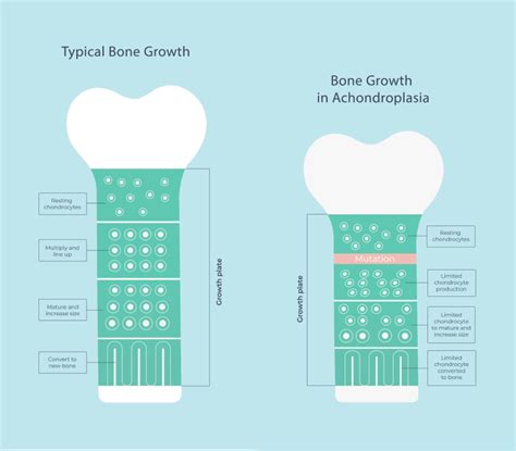 Achondroplasia Chart