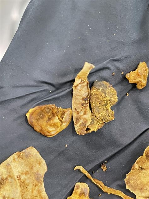 dead liver flukes in stool? : r/ClinicalMicrobiology