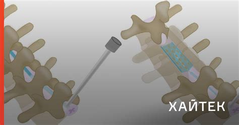 Спинальный имплант надувается и блокирует боль в ногах и спине