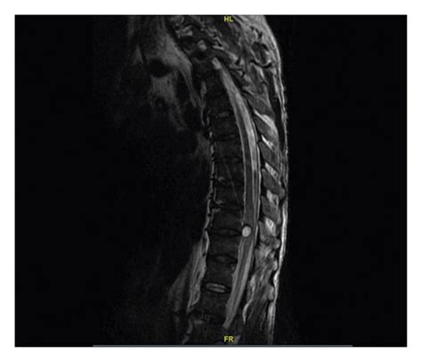 T2 MRI of the entire spine demonstrating a significant increase in the ...