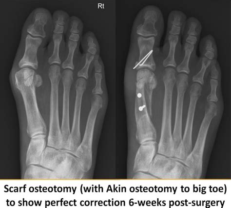 Bunion Surgery