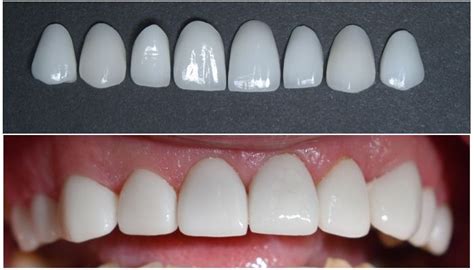 Люминиры на зубы: установка, описание, фото, отзывы, минусы и плюсы