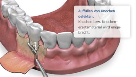 Knochenaufbau Vor Implantaten Zahnarztpraxis Leipziger