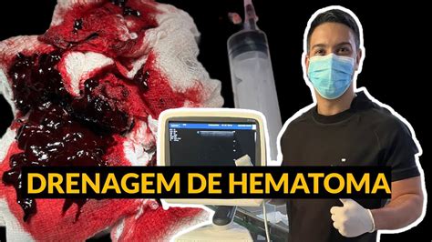 Drenagem De Hematoma Haematoma Drainage DR LUCAS DUARTE JAN22