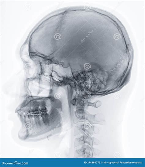 X Ray Image Of Human Skull Lateral View For Diagnosis Skull Fracture