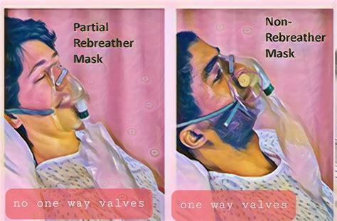 Partial Rebreather Mask