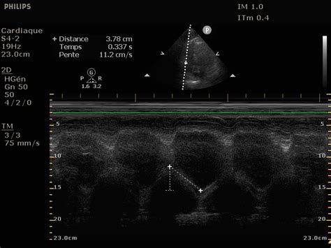 Cours Us Cœur Evaluation Fonction Systolique Du Vd