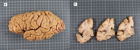 a: Moderate atrophy of medial temporal lobe and mild atrophy of frontal ...