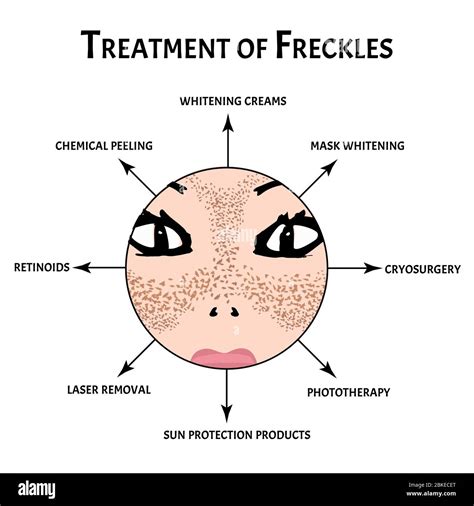 Freckles On The Face Pigmentation On The Skin A Pigmented Spot On The