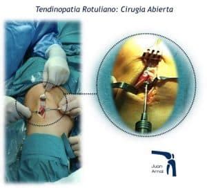 Lesion Del Tendon Rotuliano Tendinitis Rotuliana Juan Arnal