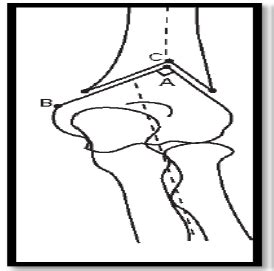 Reverse V Osteotomy Of The Distal Humerus For The Correction Of Cubitus