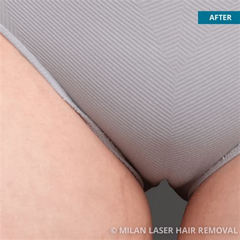 H Nh Nh K T Qu Tr C V Sau Khi Tri T L Ng Bikini Spa L M P Th M M Sen