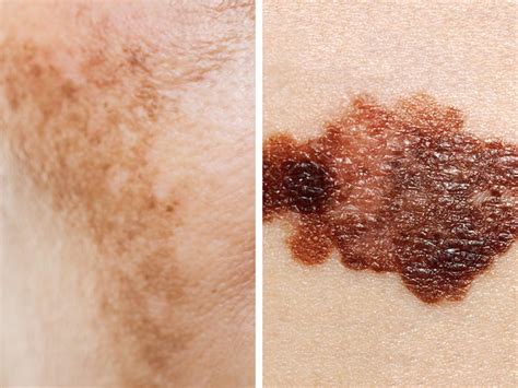 Cancerous Skin Moles What To Look For