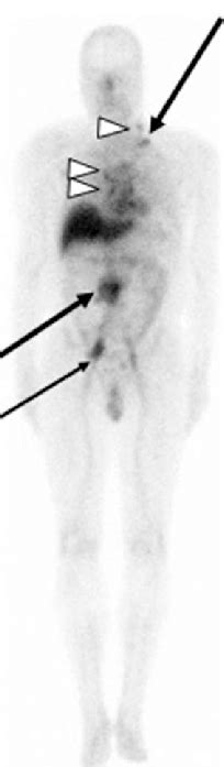 Planar Anterior Whole Body Scan Obtained Hours After Iv