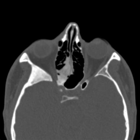 Fibrous Dysplasia Of Right Maxilla Image