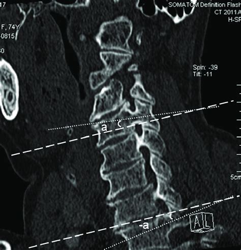 Computed Tomography Reconstruction Of Cervical Oblique Sagittal Image